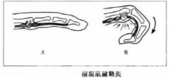 徐州市康复医院医生提醒：小小腱鞘炎，需要大注意
