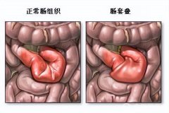 什么是急性肠套叠？徐州儿科专家详解儿外科常见的急腹症