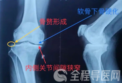 骨关节炎的发病因素有哪些？徐州康复医院为你科普