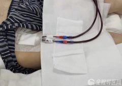 徐州一院肾内科：中心静脉置管后，要注意哪些？